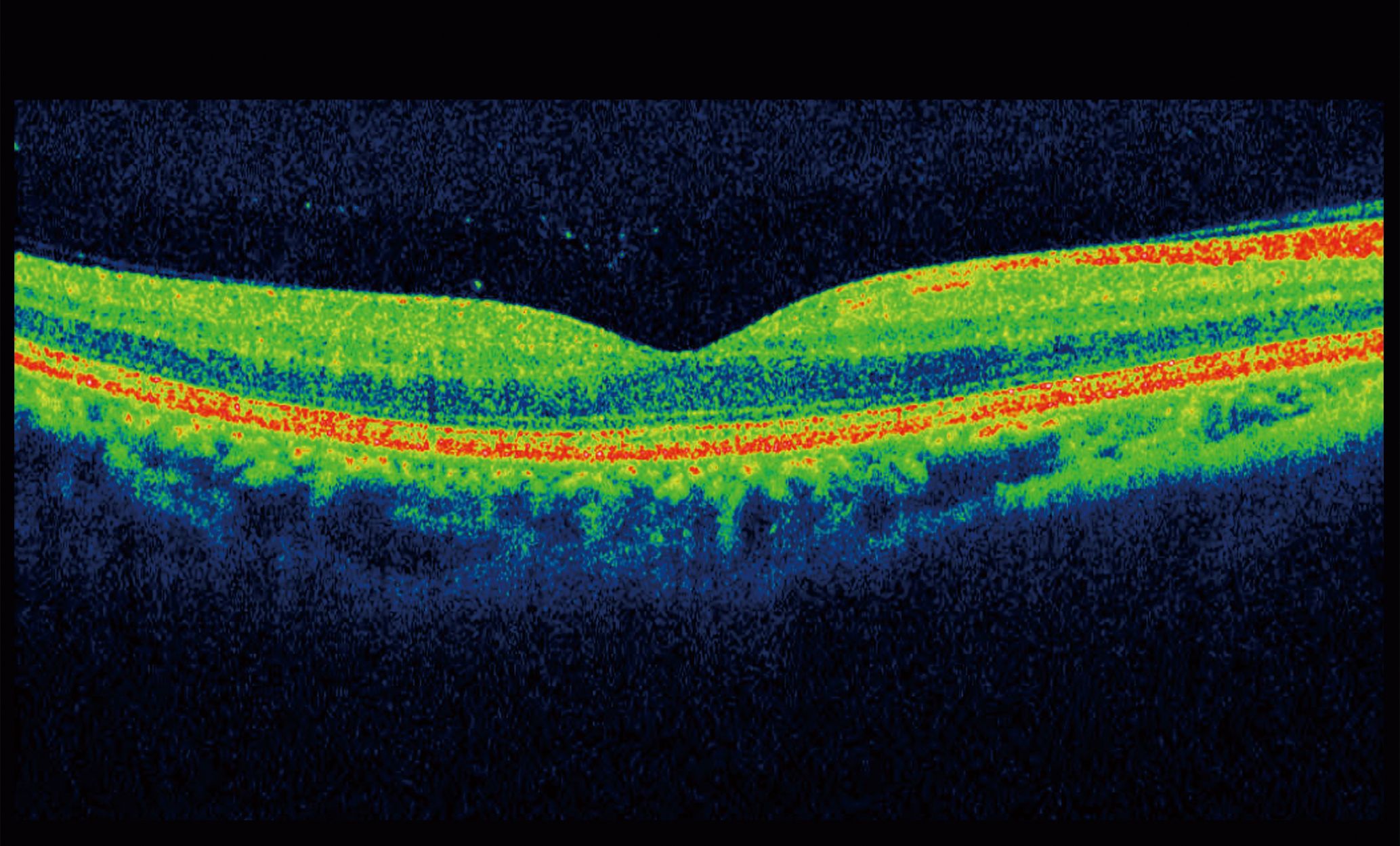 Optical Coherence Tomography
